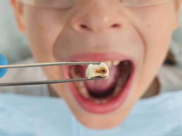 Best Broken or Chipped Tooth Repair in Sleepy Hollow, IL